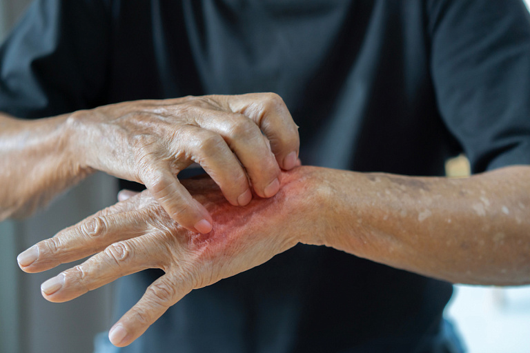 Заболеть может каждый: врач рассказала, как уберечься от псориаза