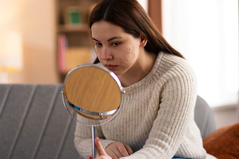 О важных нюансах в лечении акне рассказала белорусский дерматолог